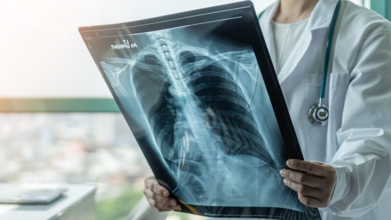 Malaysia risks under-reporting of TB cases as ‘slow-burn epidemic’ persists