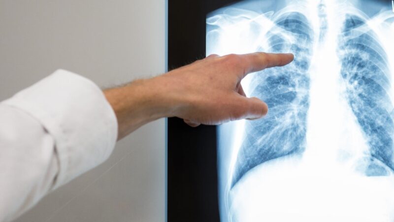 Malaysia’s tuberculosis cases rise to above 3,000, health ministry flags risks
