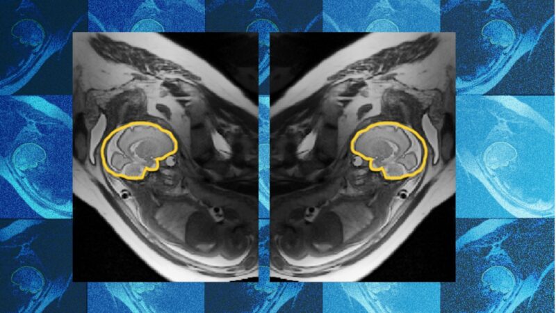 Why teaching AI about symmetry could make prenatal diagnosis more reliable